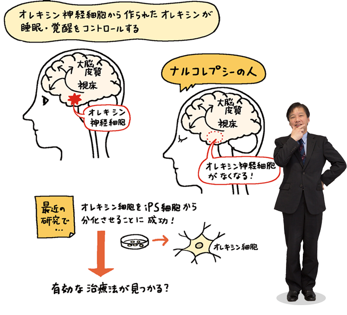 イラスト：オレキシン産生細胞はナルコレプシー患者から特異的に消えてしまう