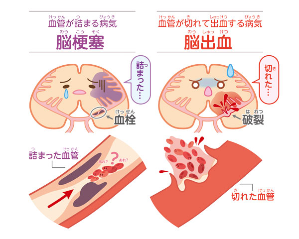 脳梗塞・脳出血