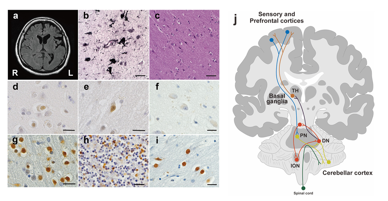 Fig 1. Overview: Neuropathological findings and pentosidine positive neurons in a schizophrenia patient with a GLO1 frameshift mutation (GLO1-FS).