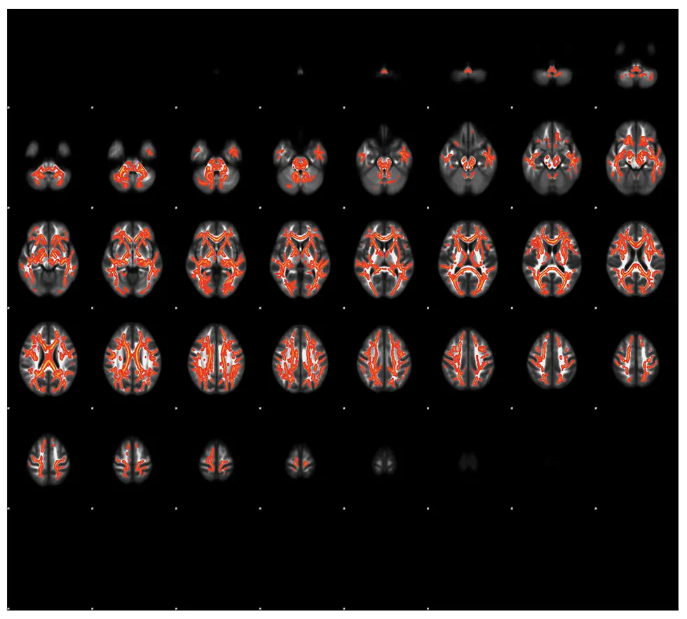 図1.統合失調症患者における大脳白質の広範なFA値の低下