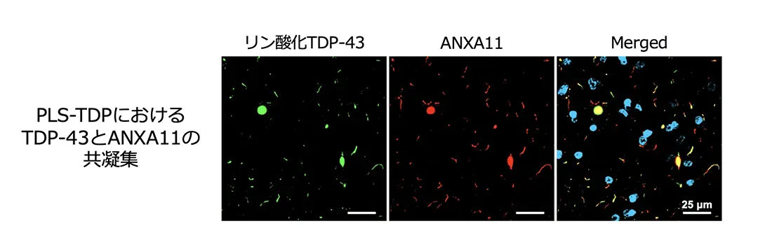 図1 PLS-TDPの神経病理学的特徴