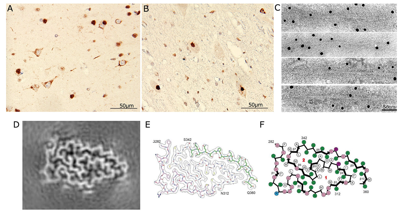 Structure of pathological TDP-43 filaments from ALS with FTLD