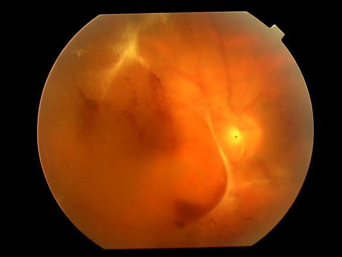 図8．増殖網膜症の眼底写真