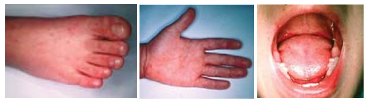 手足口病における水疱性発疹