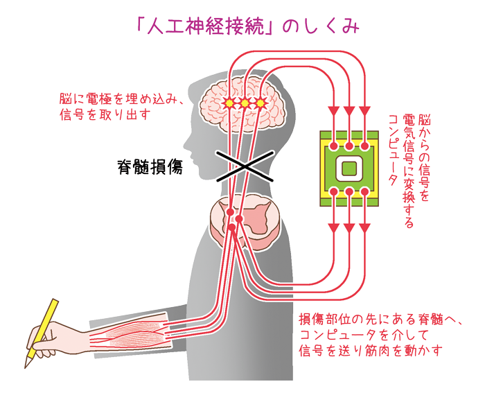 「人工神経接続」のしくみ