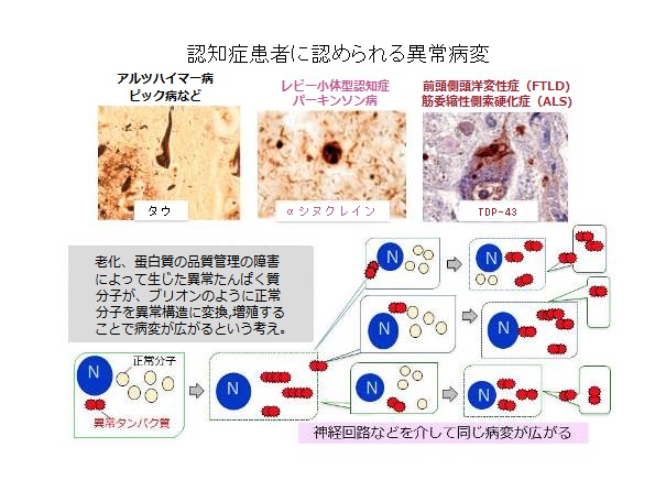 図１：認知症患者に認められる異常病変