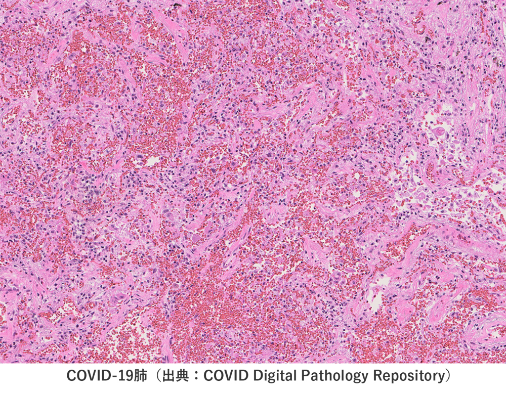 COVI-19肺