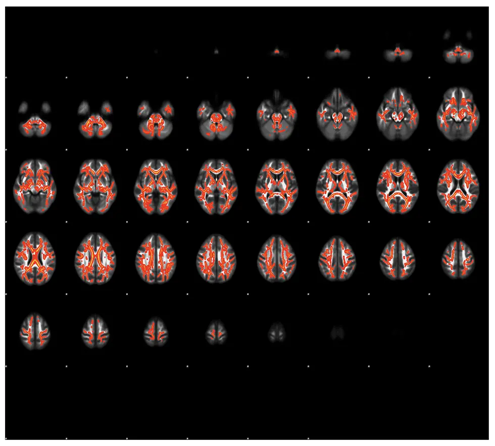 Fig.1：Areas with significant FA reduction in individuals with SZ.