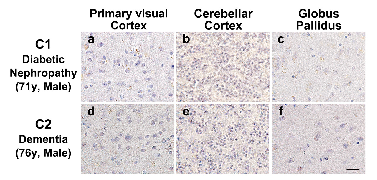 Fig. 3. Control cases: No accumulation of pentosidine in patients with diabetic nephropathy and dementia