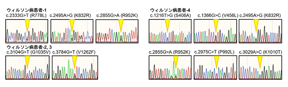 図1:4名のウィルソン病患者から検出されたATP7B遺伝子変異