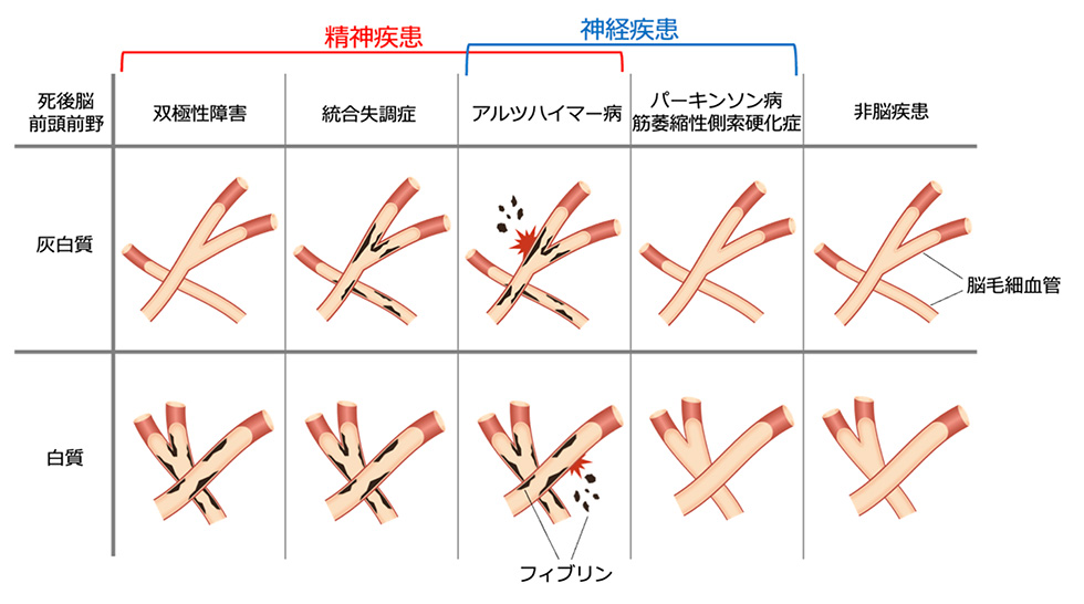 図1.精神・神経疾患における脳毛細血管の特徴的な障害