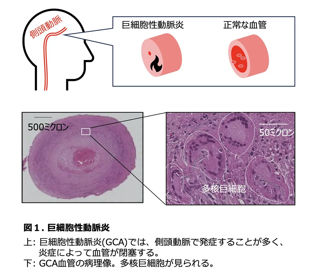 図1 巨細胞性動脈炎