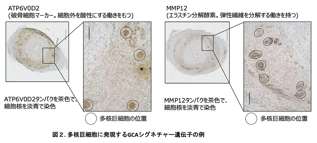 図2 多核巨細胞に発言するGCA血管シグネチャー遺伝子の例