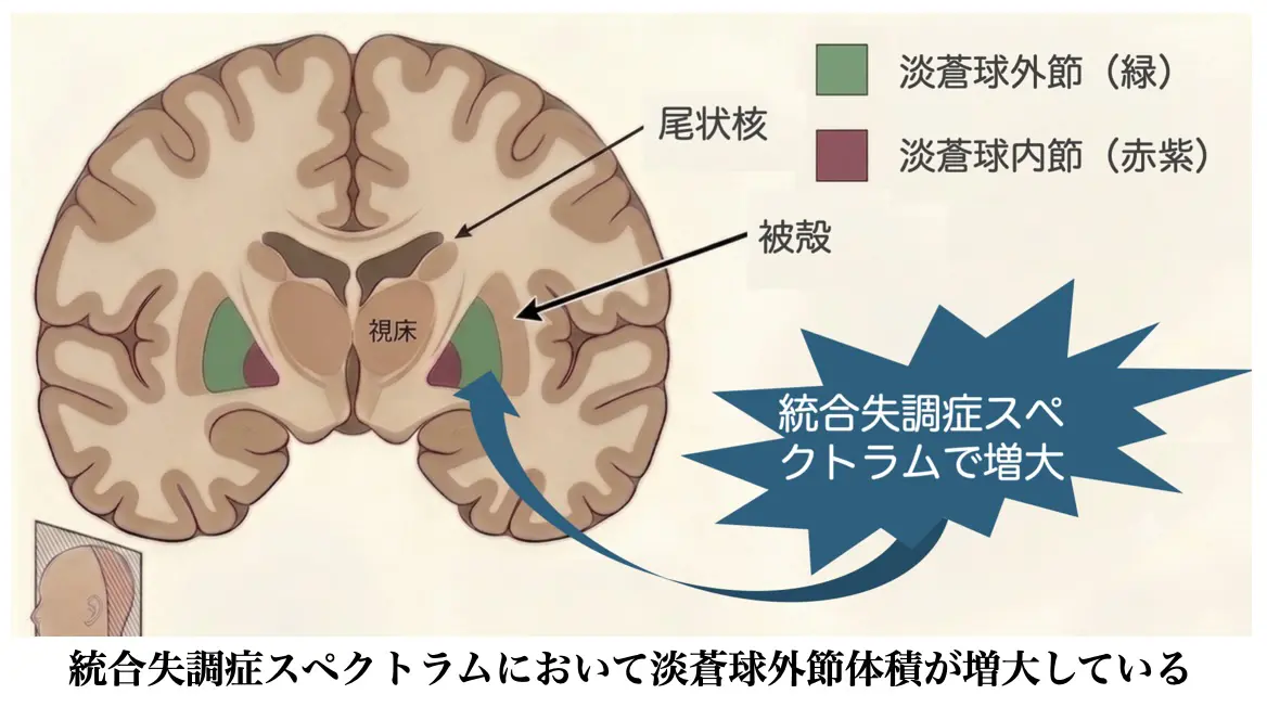 図:統合失調症スペクトラムにおいて淡蒼球外節体積が増大している